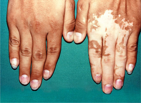 hutchinsons melanotic freckle picture Lentigo maligna and lentigo maligna melanoma