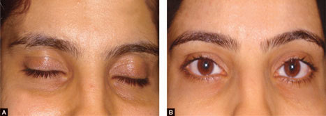 argi peel for dark circles