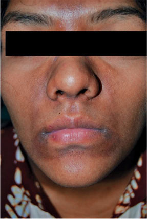 melanotic hyperpigmentation Clinical and Dermoscopic Evaluation of Periorbital Melanosis and Its  Psychological Impact and Effect on Quality of Life: A Descriptive Study main image 1
