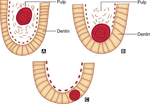 Pulp Stones Histology Diagram