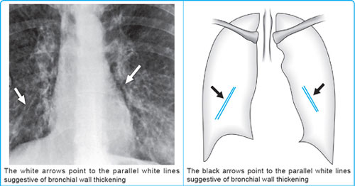 Chest Panel Line Tram Lines Chest X Ray