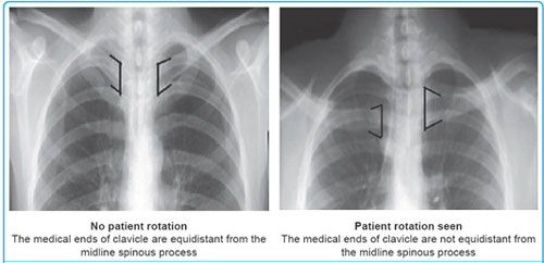 Chest X Ray Rotation
