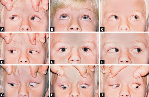 What Is Inferior Oblique Overaction