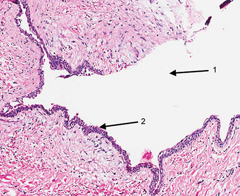 Epulis Fissuratum Histology