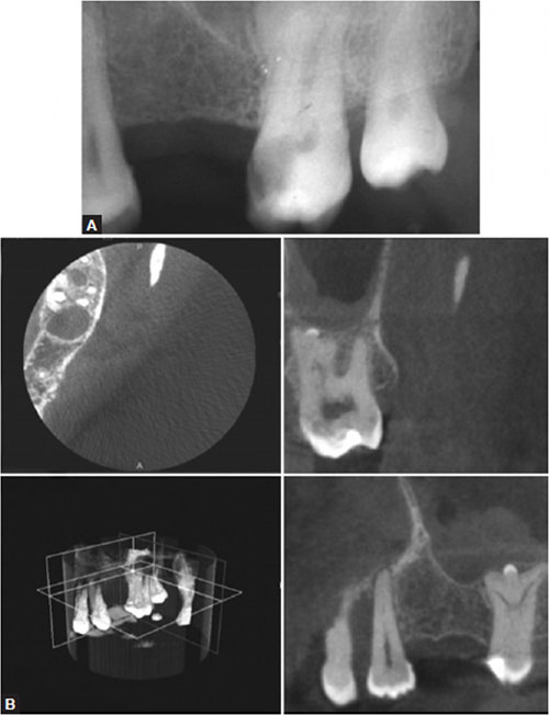 Enamel Pearl Radiograph
