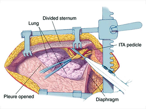 Lima Dissection Lima Artery Anatomy JaypeeDigital | EBook Reader