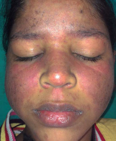oral melanotic macule vs melanoma Pigmented Lesions of the Oral Mucosa