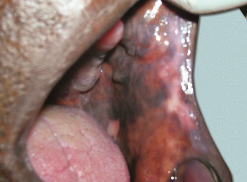 hutchinson's melanotic freckle Labial melanotic macule main image 0