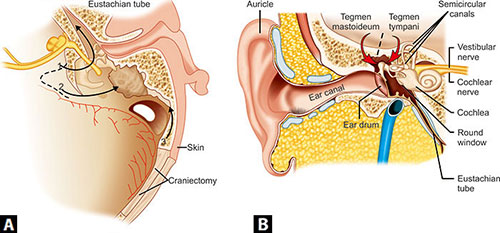 Symptoms Of A Cranial CSF Leak Brain Spine Center, 54% OFF