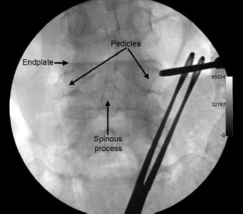 here’s SPINAL SINGLE PIERCE JaypeeDigital | eBook Reader