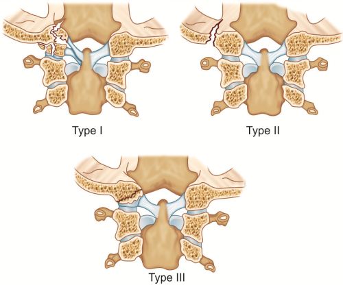 Occipital Condyle Fracture Grading