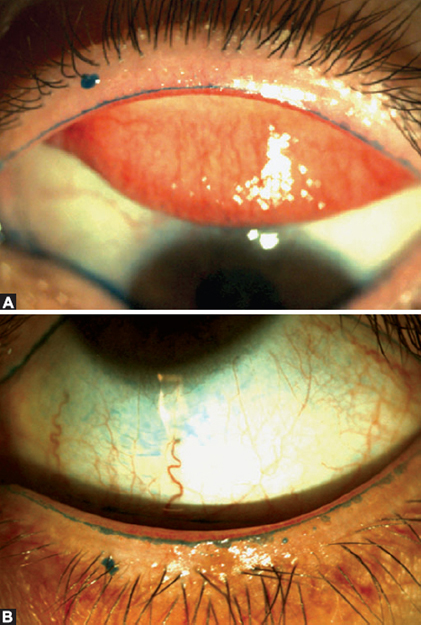 l carnitine upper eyelids Lower Blepharoplasty Seattle JaypeeDigital | eBook Reader