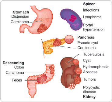 bilharzial pericolic mass