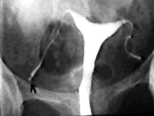 what happens if you swallow a tobacco pouch Swallowed a Nicotine Pouch? What Happens Next