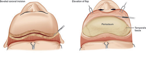 Coronal Approach