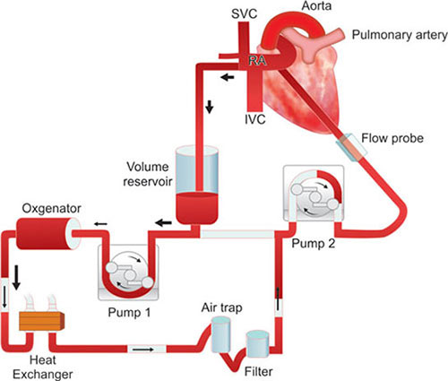 Cardiopulmonary Bypass Cardiopulmonary Bypass