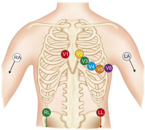 12 Lead ECG Placement Guide With Illustrations 40 OFF 12 Lead ECG Placement Guide With Illustrations 40 OFF