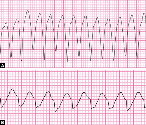 Example Of Monomorphic Ventricular Tachycardia