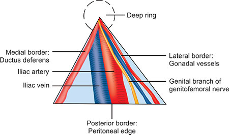 Triangle Of Doom Hernia
