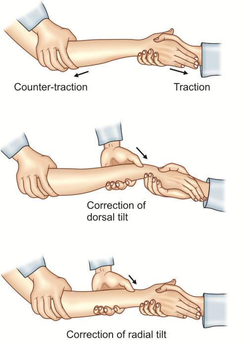 Colles Fracture Treatment Colles Fracture Treatment