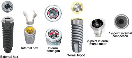 External Hex Connection Types Of Implant Connections