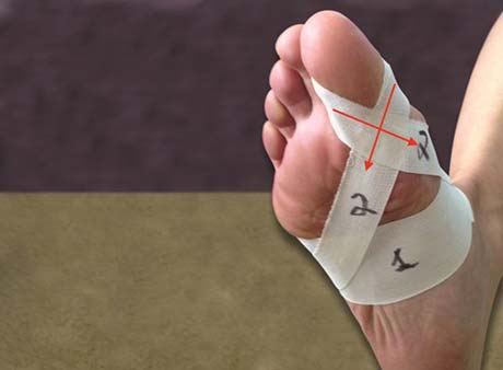 bpc 157 for turf toe Peptides and the Role They Play in Treating Foot Pain Injury update! Several torn ligaments