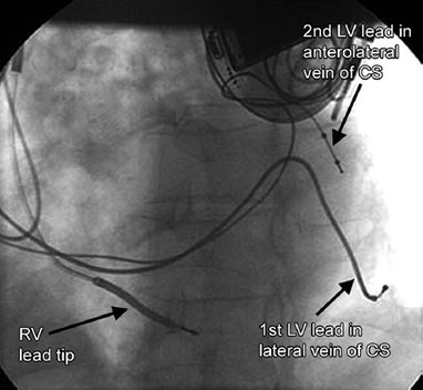 Coronary Sinus Lead Ct