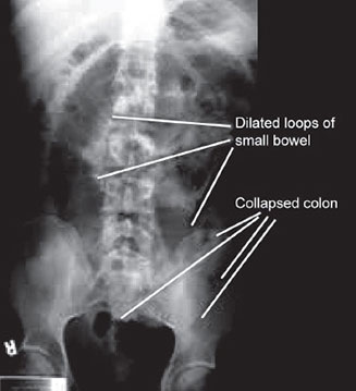 Sentinel Loop Pancreatitis