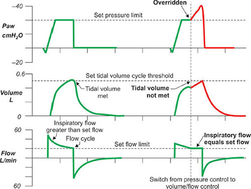 vaps ventilation mode Respiratory Therapy for Neuromuscular Disorders - main image 0