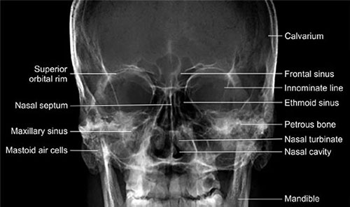Radiographic Anatomy Sinuses Pa 15 Caldwell