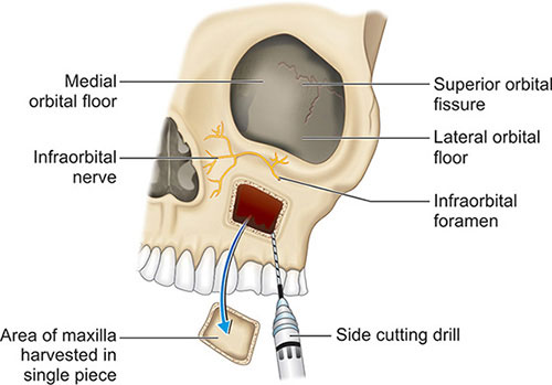 Infra Orbital Rim