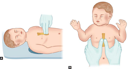 Baby Inverted Inverted Sternum Baby