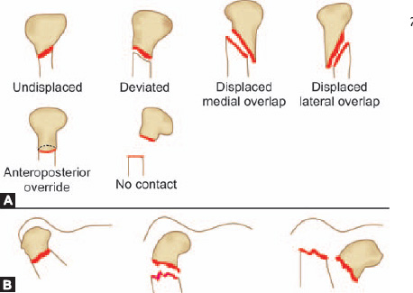 Mandibular Condyle Fracture Ppt