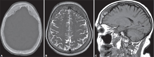 telangiectasia radiopaedia telangiectasia radiopaedia