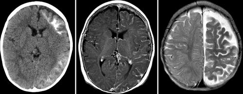 pelvic venous congestion radiopaedia pelvic venous congestion radiopaedia