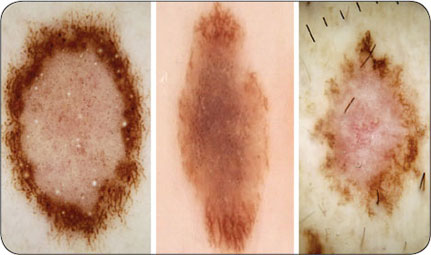 melanocytic nevus vs melanotic macule Pigmented Oral Lesions: Clues to Identifying the Potentially Malignant