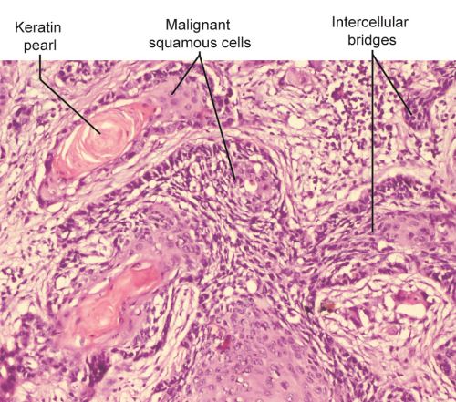 Intercellular Bridges In Scc
