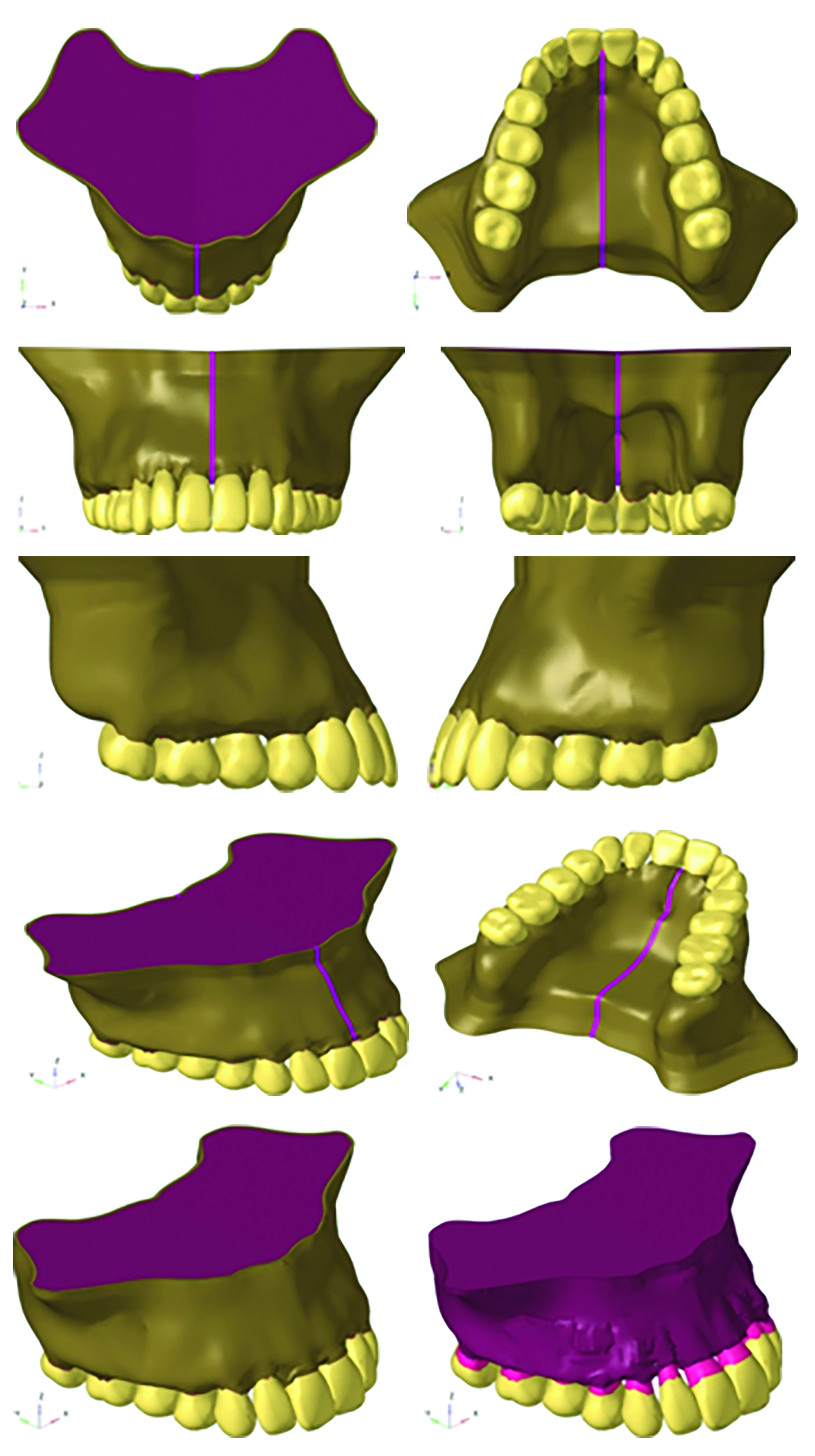Comparison of Stress Distribution and Displacement of Skeletal, Dental ...