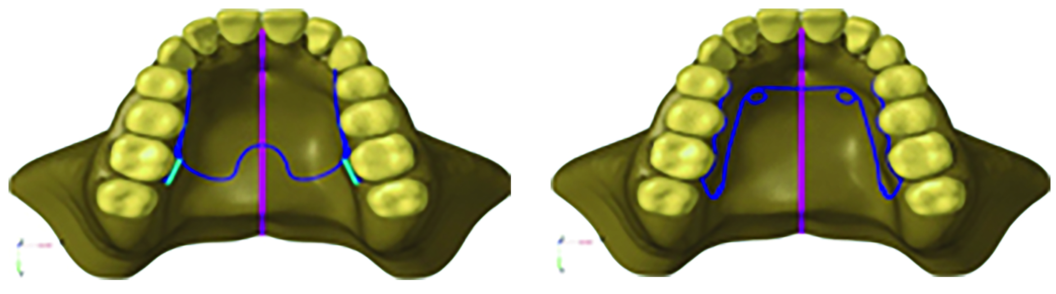 Comparison of Stress Distribution and Displacement of Skeletal, Dental