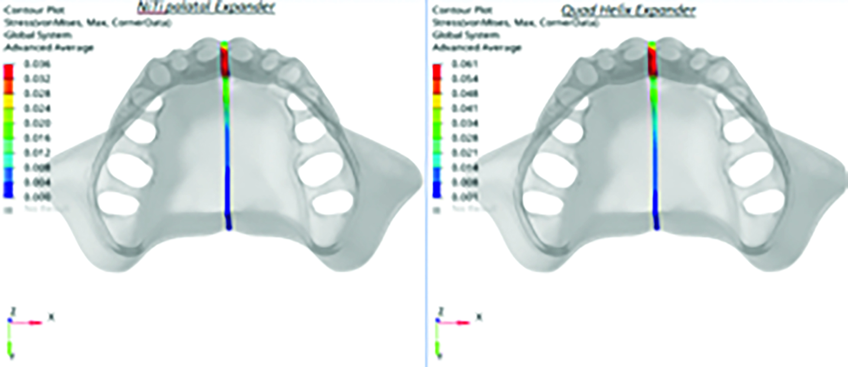Comparison of Stress Distribution and Displacement of Skeletal, Dental