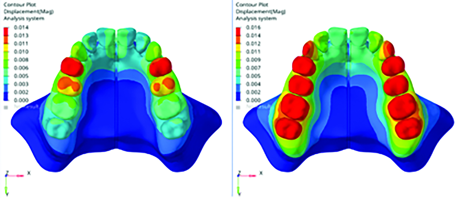 Comparison of Stress Distribution and Displacement of Skeletal, Dental