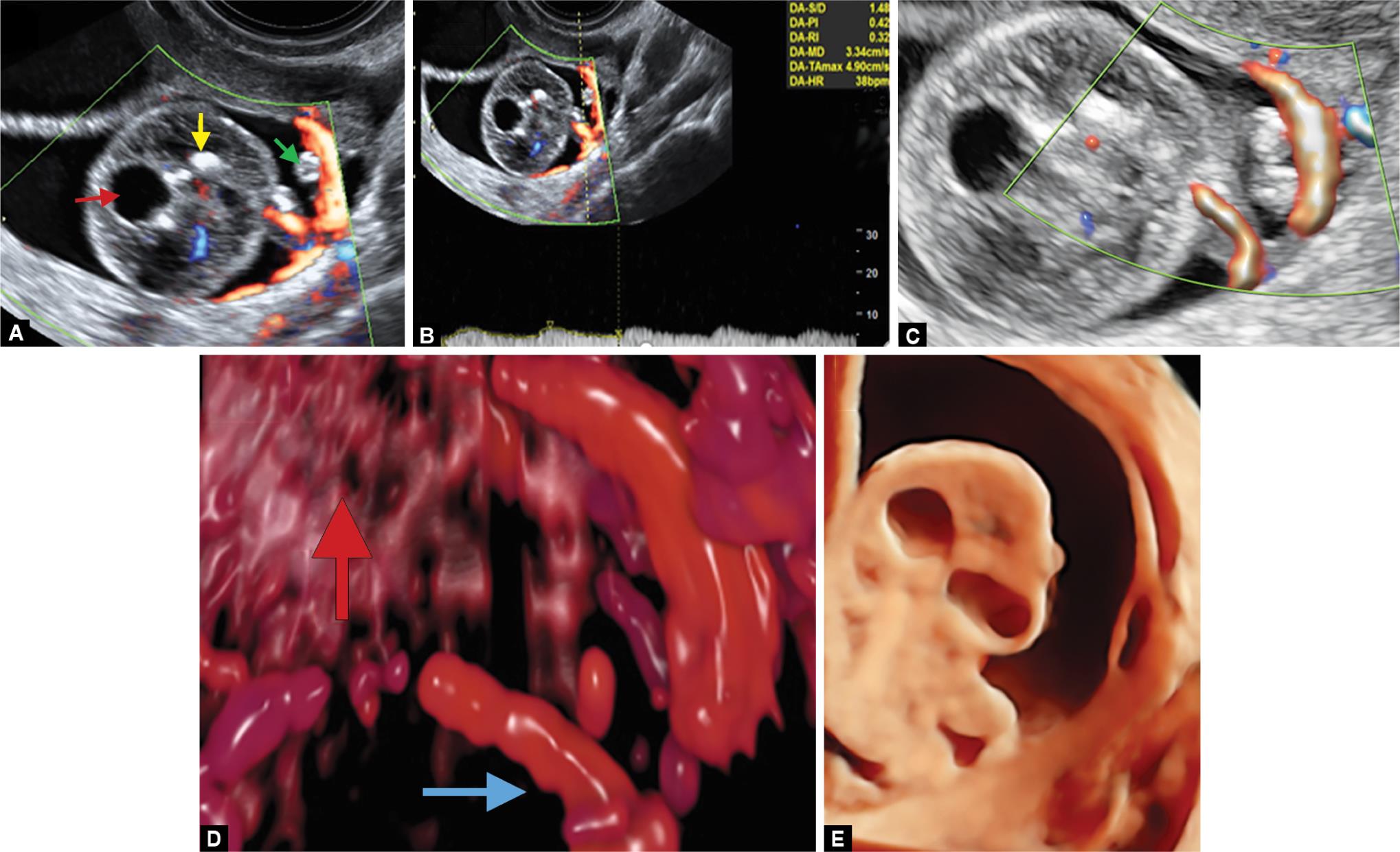 Cystic Teratoma Ultrasound Cystic Teratoma Ultrasound