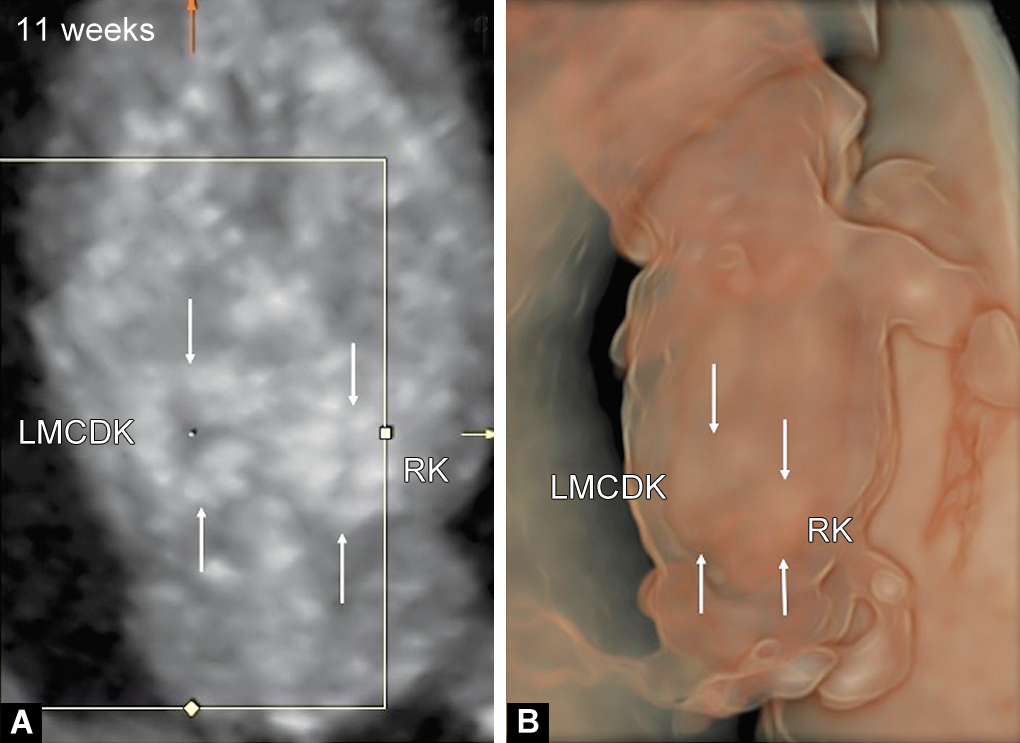 Mcdk Ras Multicystic Dysplastic Kidney of Fetus in First Trimester of Pregnancy