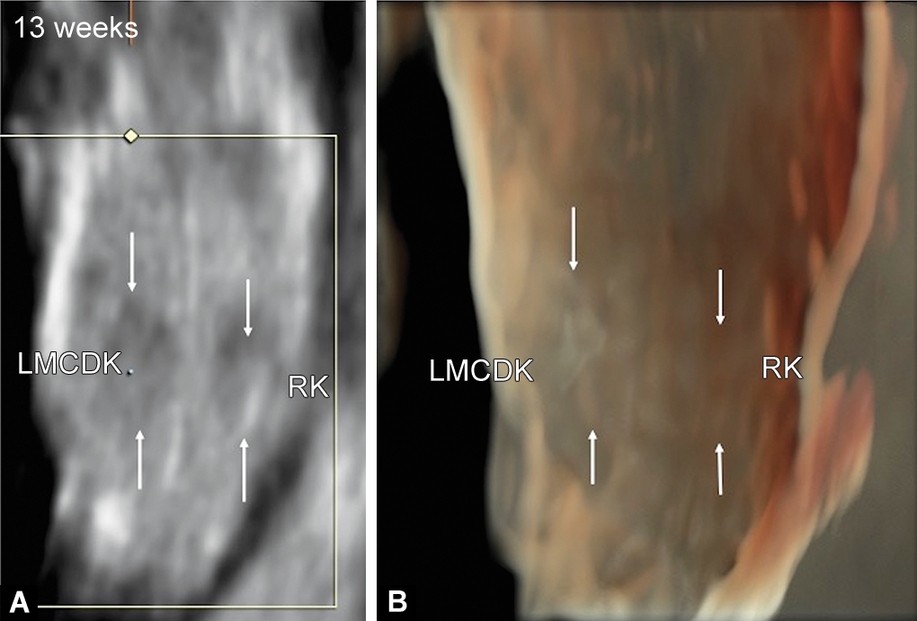 Mcdk Ras Multicystic Dysplastic Kidney of Fetus in First Trimester of Pregnancy