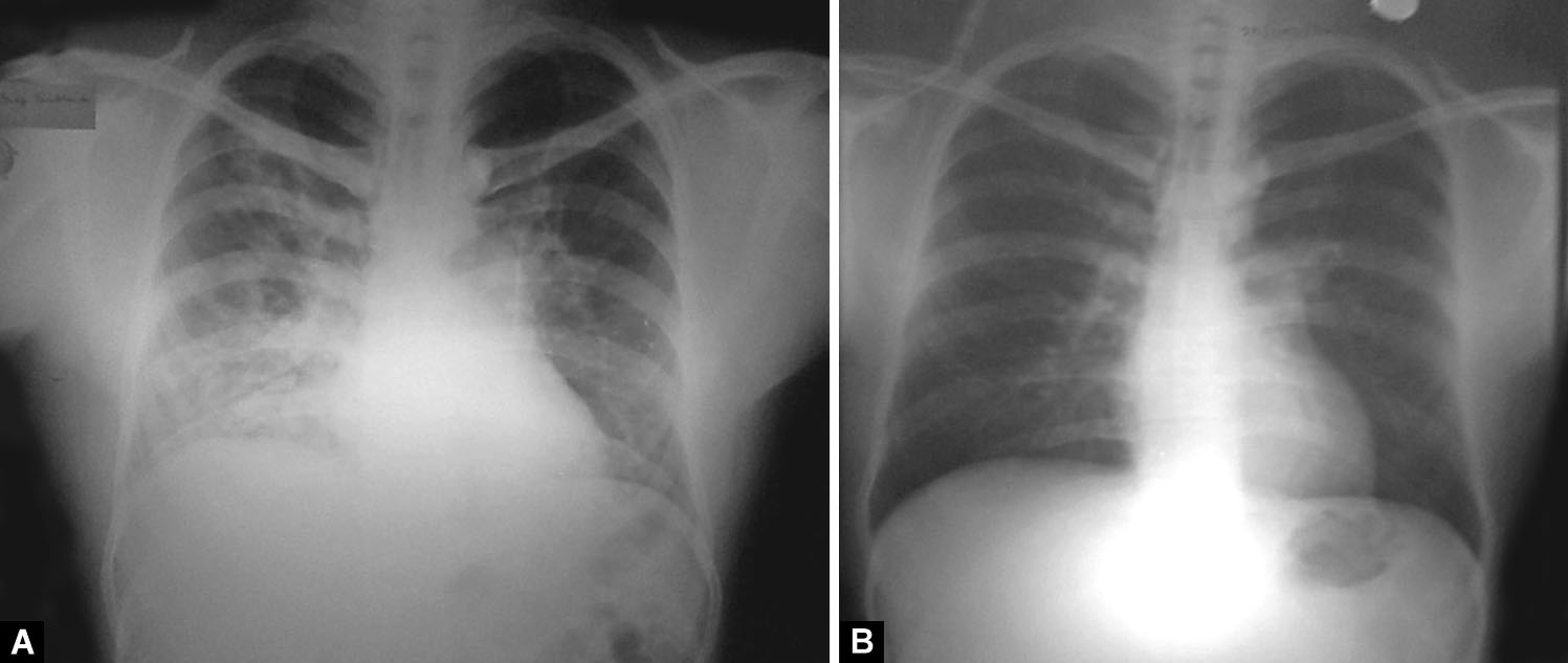 Radiographical Spectrum of High-altitude Pulmonary Edema: A Pictorial Essay