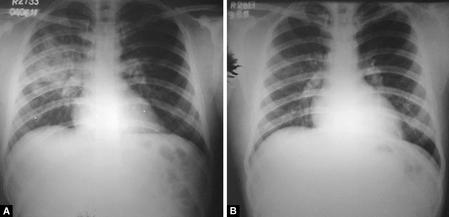 Radiographical Spectrum of High-altitude Pulmonary Edema: A Pictorial Essay