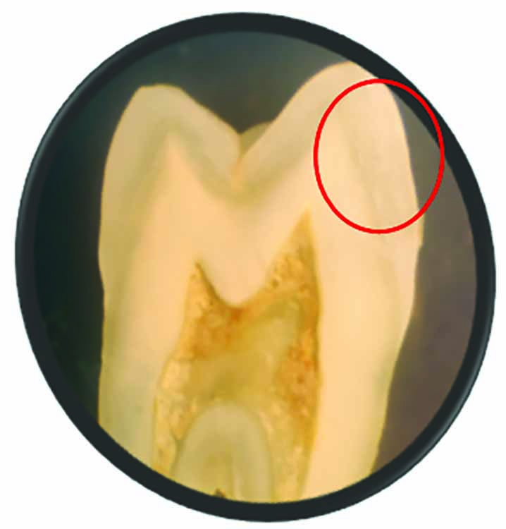 A Comparative Evaluation of Remineralizing Potential of Commonly Used