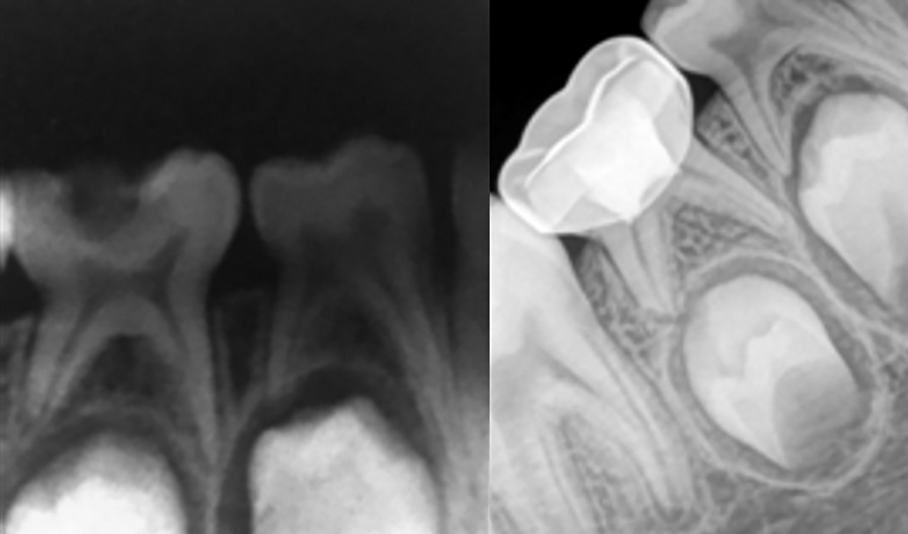 Comparative Evaluation of Lowlevel Diode Laser and Electrosurgical