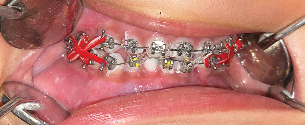 Lot De 4 Attelles Orthodontiques/d'arc Dentaire Pour Fracture De Mâchoire Supérieure - Neuves