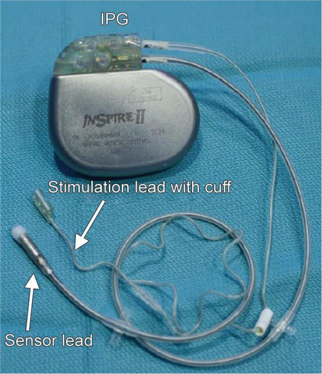 Hypoglossal Nerve Stimulator Surgery: Postoperative Care, Device Settings &  Side Effects